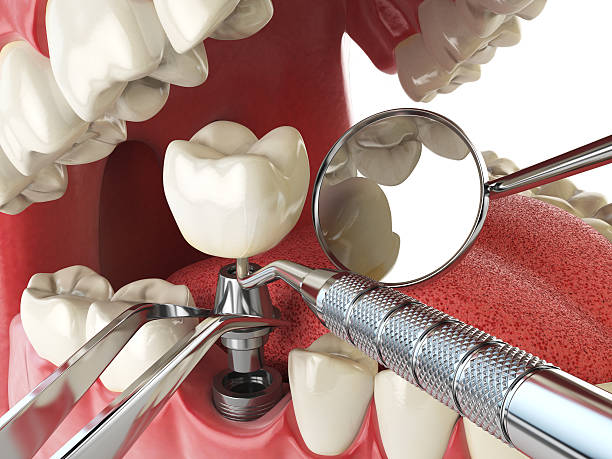 Best Emergency Treatment for Dental Infections or Abscesses in Middleburg, FL